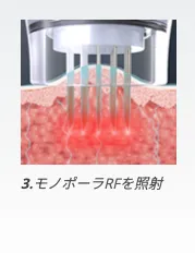 モノポーラFRを照射